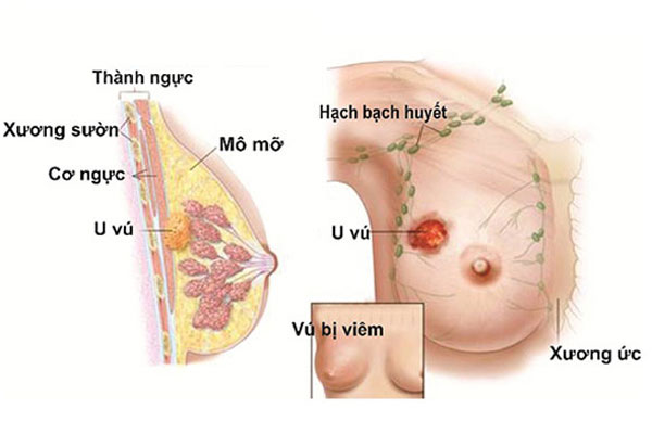 viem-tuyen-sua