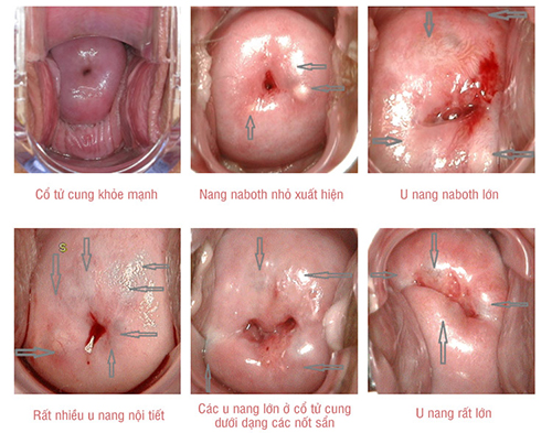 4. Mức độ nguy hiểm của u nang cổ tử cung