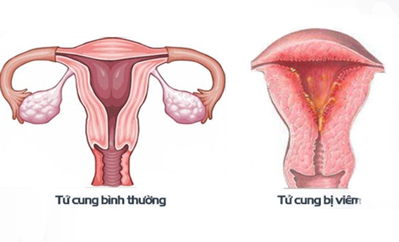 4. Điều trị viêm niêm mạc tử cung